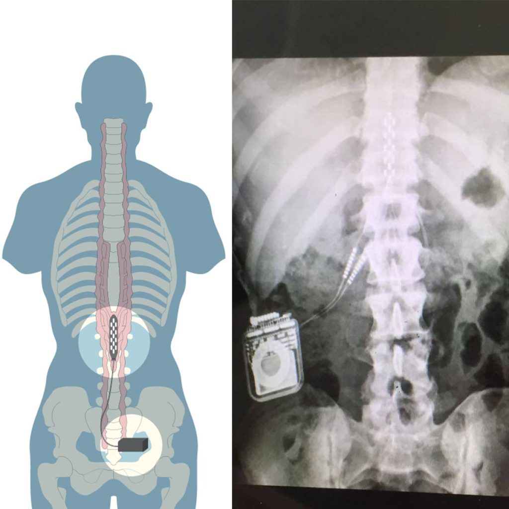 epidural-stimulation-x-ray-device