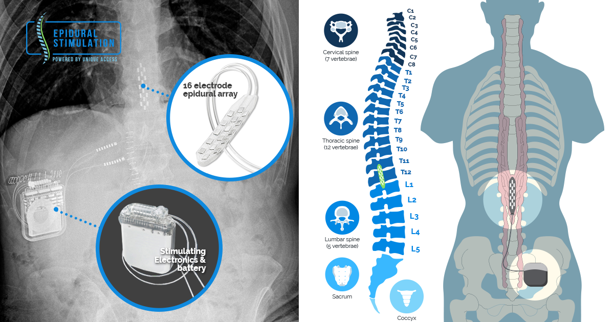dorsal column spinal cord stimulation