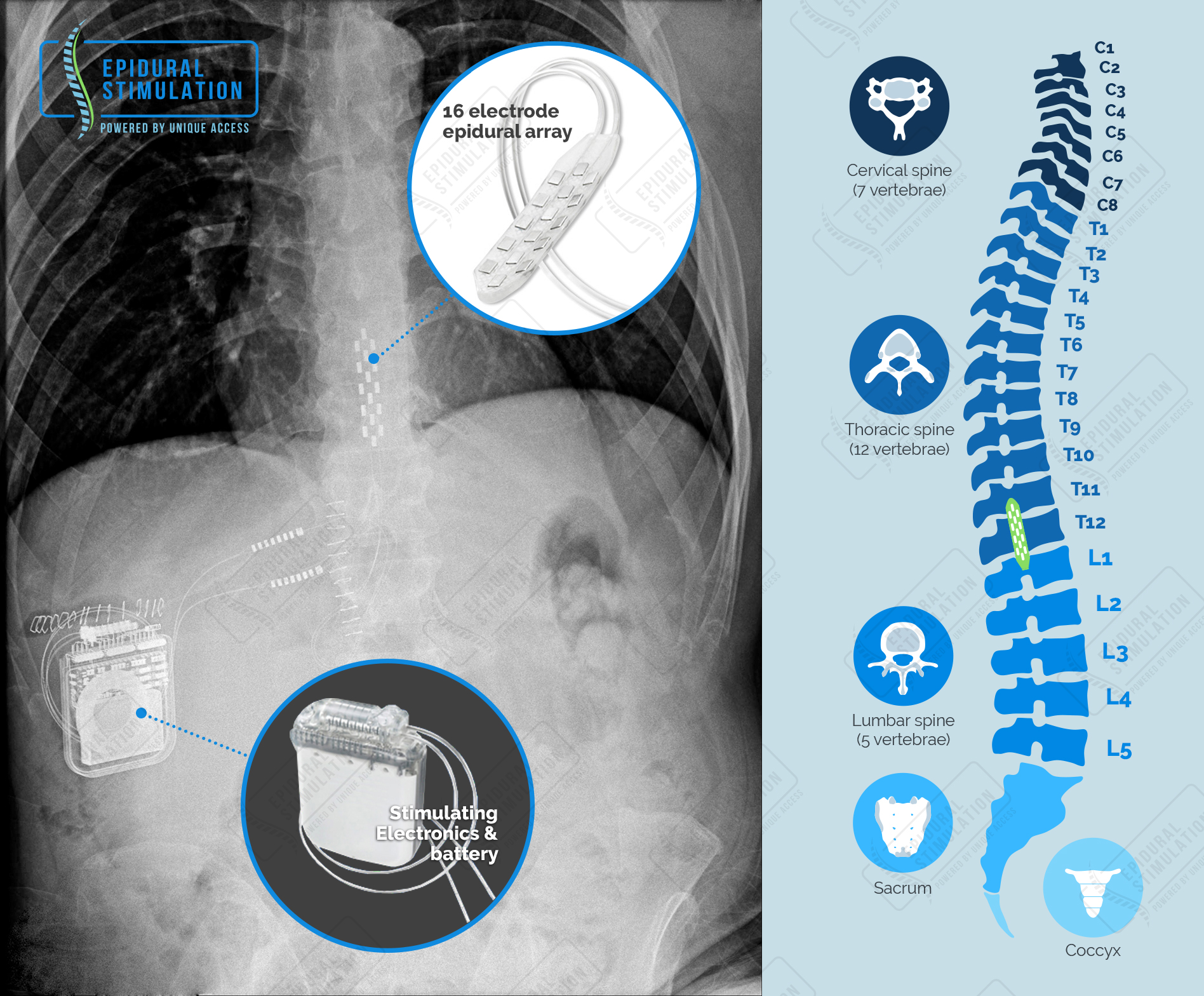 Electrical implant reduces 'invisible' symptoms of man's spinal cord injury Adaptive