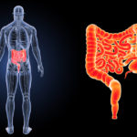 Epidural Stimulation for bladder and bowel improvement - Epidural Stimulation Now